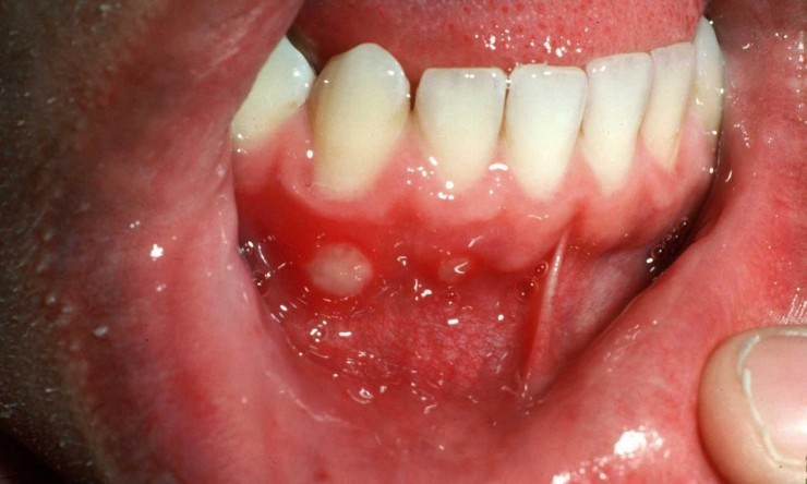 Oral Ulcers What Are The Causes And Treatments Of Mouth Ulcers