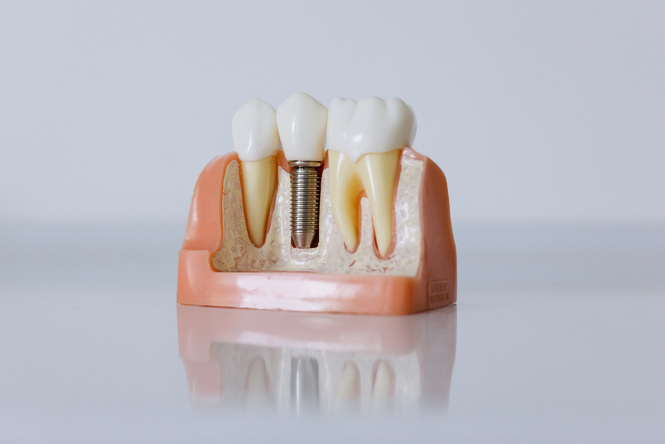 Dental implant model