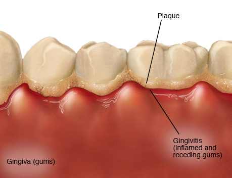 The effects of plaque built-up leading to Gingivitis